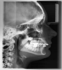 profilni telerendgen snimak