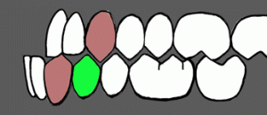 Istureni donji prednji zubi
