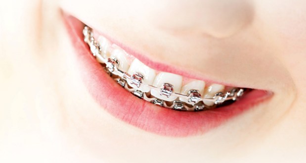 Fiksna proteza – šta da očekujem prvih 5 dana nakon postavljanja&nbsp;bravica